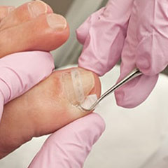 ingrown-toenail