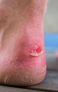 Wearing Poorly Fitting Shoes May Cause Blisters