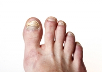 Toenail Fungus Is Contagious and Unattractive