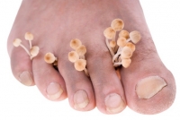 All About Toenail Fungus