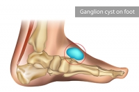 Managing Ganglion Cysts on the Feet